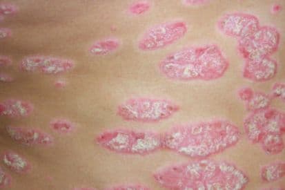 Psoriasis-example