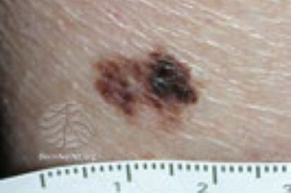 melanoma4